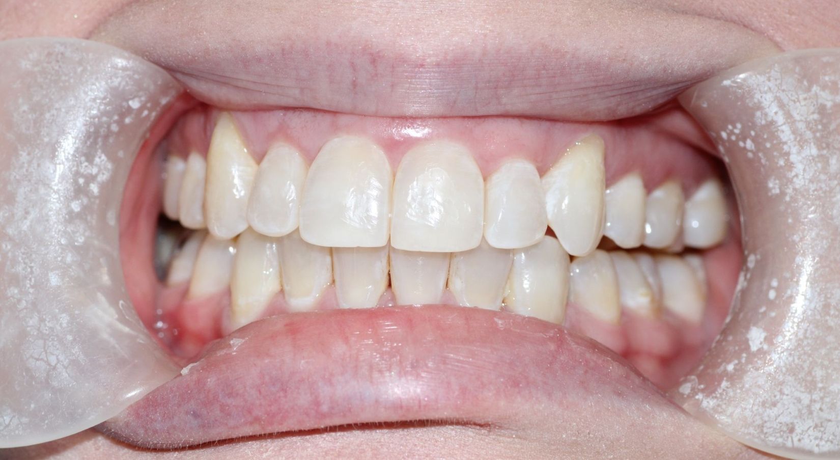 invisalignafter