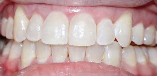 Invisalign After