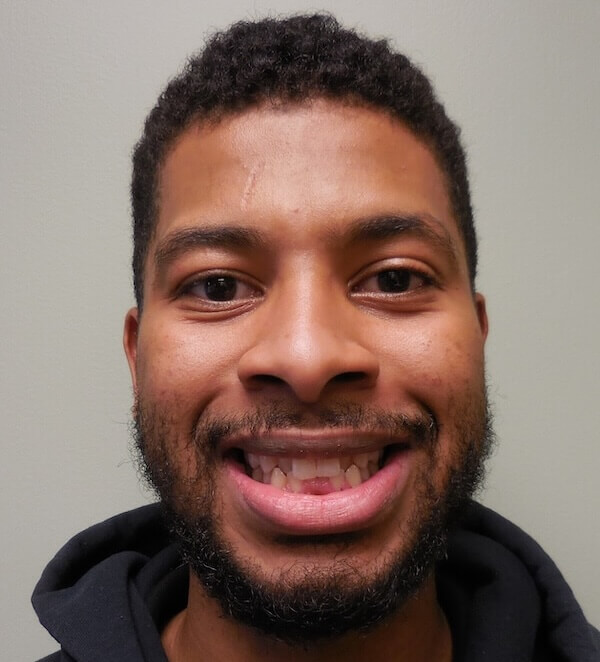 Invisalign 4 Full Face Before