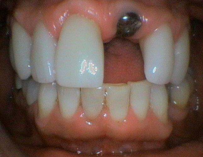 Implant before Implant before