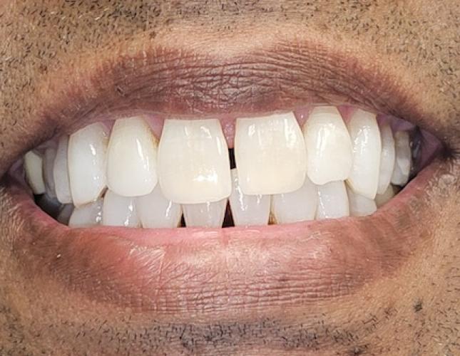 Whitening after