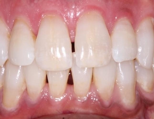 Whitening before