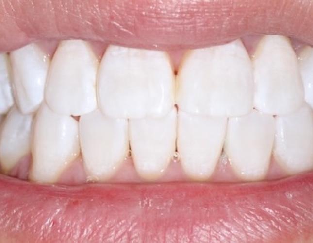 Whitening after Whitening after
