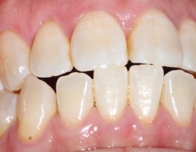 Whitening before Whitening before