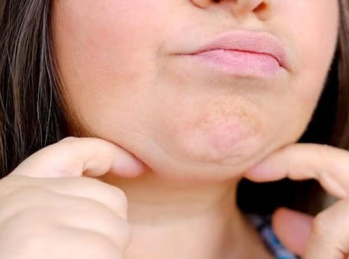 Chin Up! A Complete Guide to Chin Ptosis