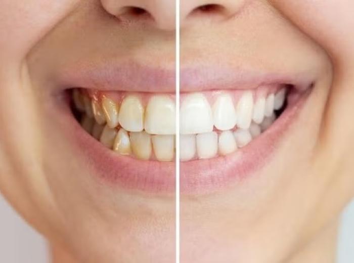 Do Natural Teeth Whitening Remedies Really Work?