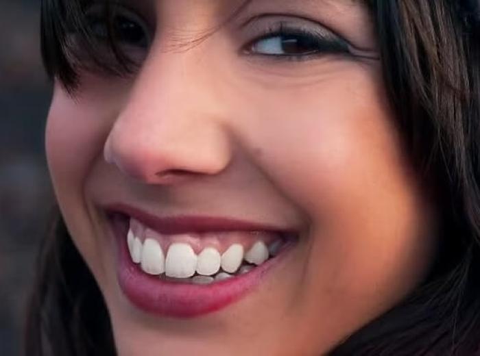 Gummy Smile Treatment: Everything You Need to Know