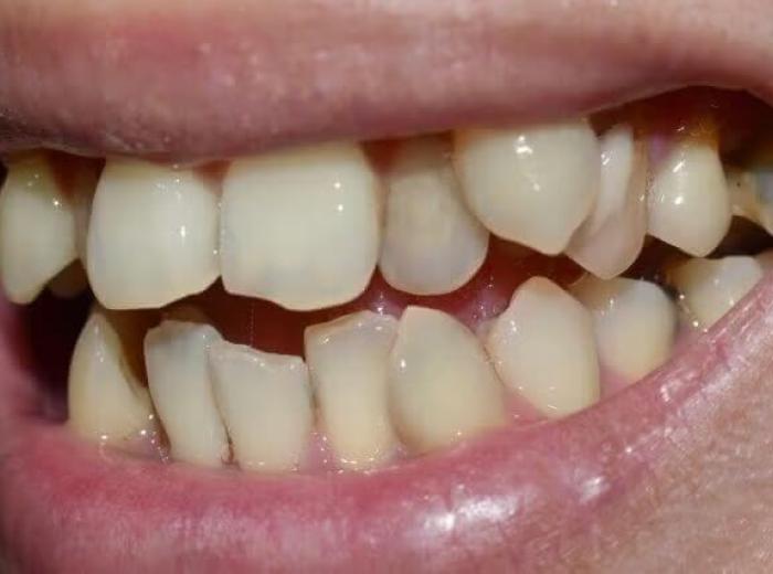 Hyperdontia: Understanding the Phenomenon of Supernumerary Teeth