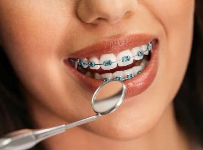 Your Guide to a Perfect Smile with Traditional Braces