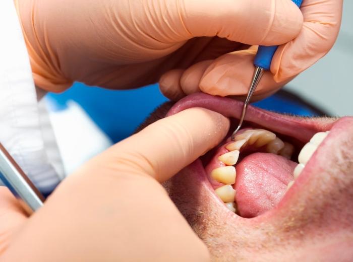 The Stages of Periodontitis: Understanding the Progression