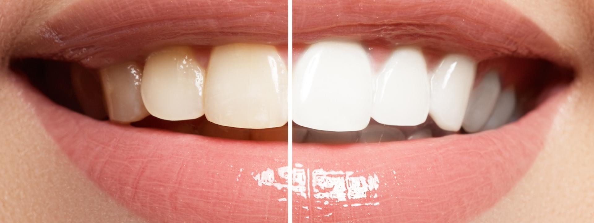 Cosmetic Dental Procedures