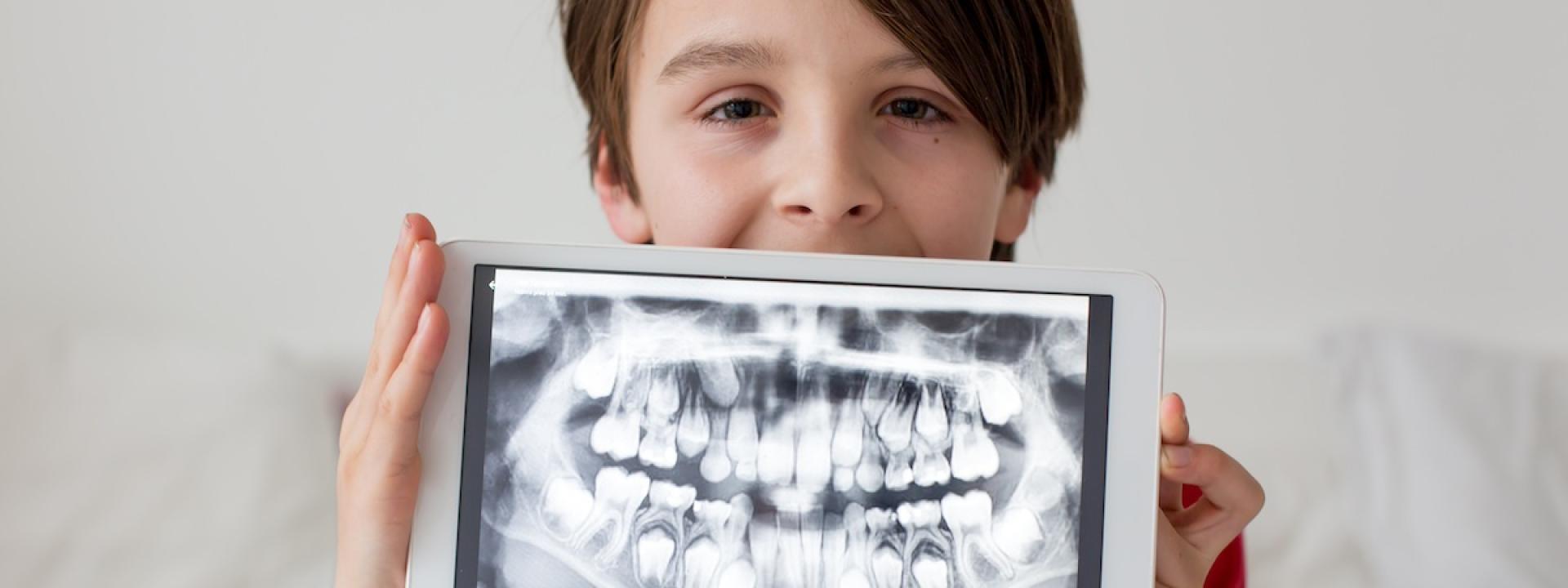 Dental X-Rays for Children