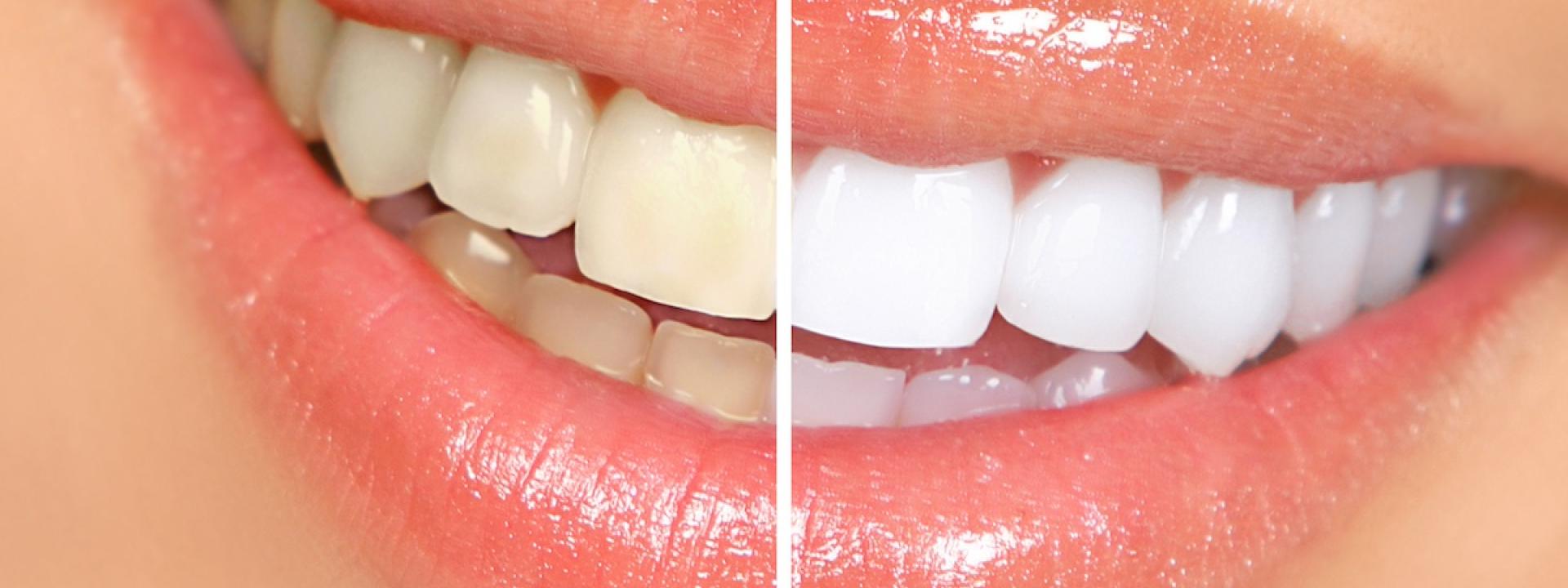 Teeth Whitening vs. Veneers